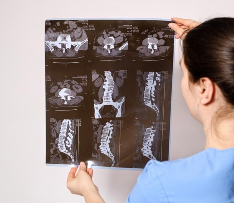 MRI Niš - Magnetna rezonanca kičme