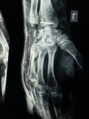 MSCT zglobova - detaljna dijagnostika