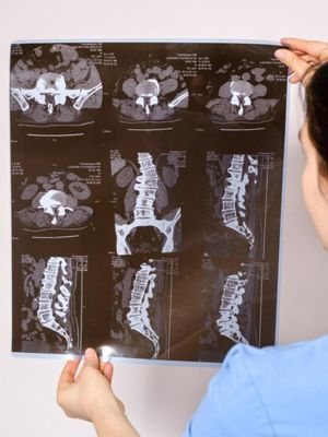 MRI Niš - Magnetna rezonanca kičme