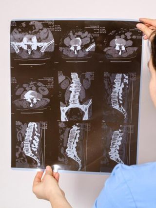 MRI Niš - Magnetna rezonanca kičme
