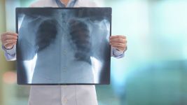 Fibrotoraks: Dijagnoza i opcije lečenja