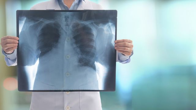 Fibrotoraks: Dijagnoza i opcije lečenja Fibrotoraks: Dijagnoza i opcije lečenja