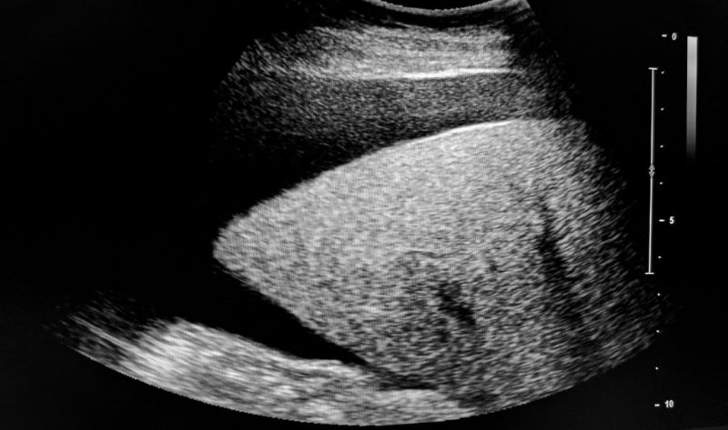 Ascites