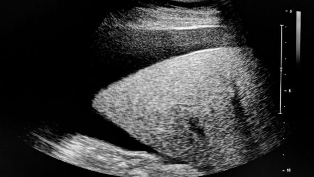 Šta je Ascites i kako se leči? Šta je Ascites i kako se leči?